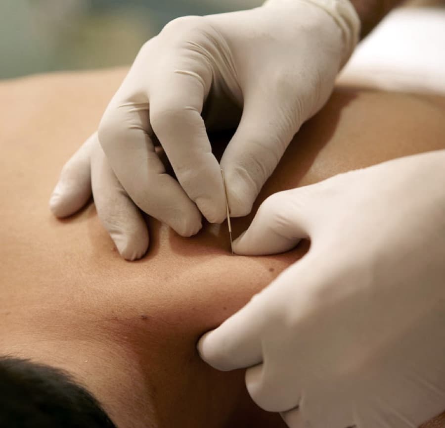 Dry Needling
